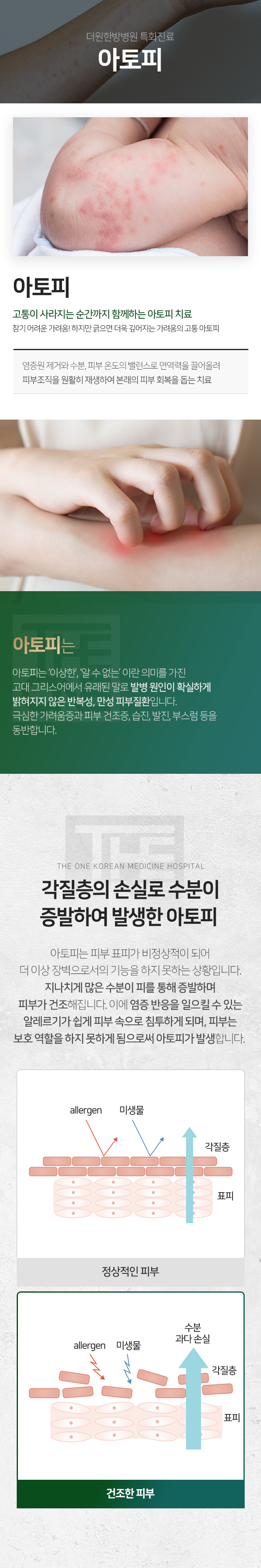 더원한방병원-특화진료-아토피-피부-표피가-비정상적이-되어-더-이상-장벽으로서의-기능을-하지-못하는-상황입니다-지나치게-많은-수분이-피를-통해-증발하며-피부가-건조해집니다-이에-염증-반응을-일으킬-수-있는-알레르기가-쉽게-피부-속으로-침투하게-되며-피부는-보호-역할을-하지-못하게-됨으로써-아토피가-발생합니다